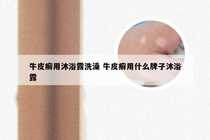牛皮癣用沐浴露洗澡 牛皮癣用什么牌子沐浴露