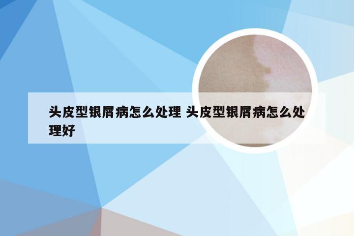 头皮型银屑病怎么处理 头皮型银屑病怎么处理好