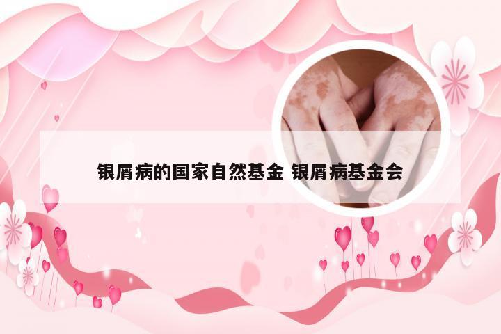 银屑病的国家自然基金 银屑病基金会