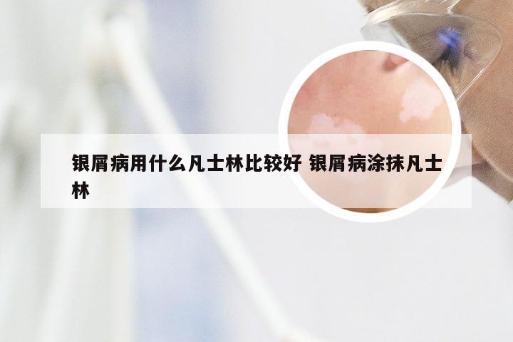 银屑病用什么凡士林比较好 银屑病涂抹凡士林