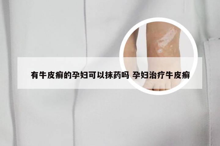 有牛皮癣的孕妇可以抹药吗 孕妇治疗牛皮癣