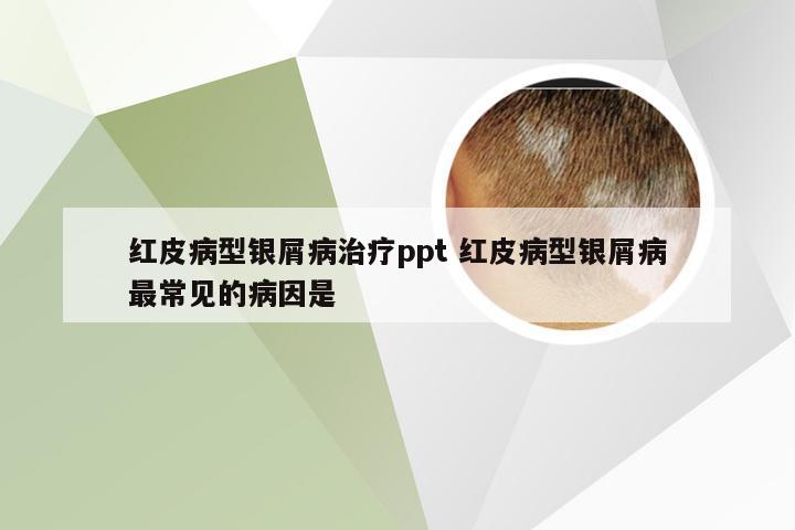 红皮病型银屑病治疗ppt 红皮病型银屑病最常见的病因是