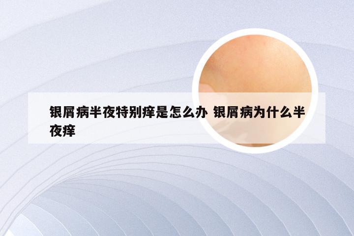 银屑病半夜特别痒是怎么办 银屑病为什么半夜痒