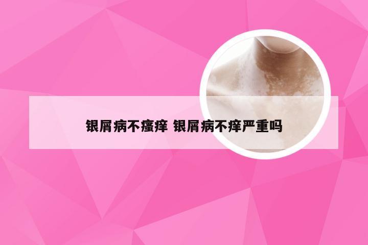 银屑病不瘙痒 银屑病不痒严重吗