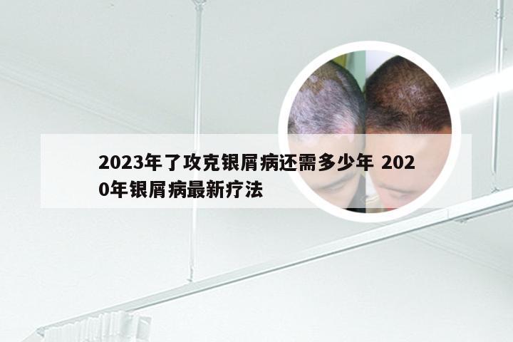 2023年了攻克银屑病还需多少年 2020年银屑病最新疗法