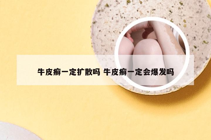 牛皮癣一定扩散吗 牛皮癣一定会爆发吗