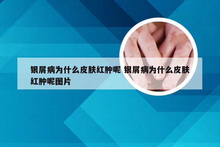银屑病为什么皮肤红肿呢 银屑病为什么皮肤红肿呢图片