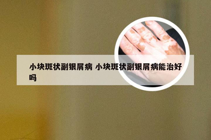 小块斑状副银屑病 小块斑状副银屑病能治好吗