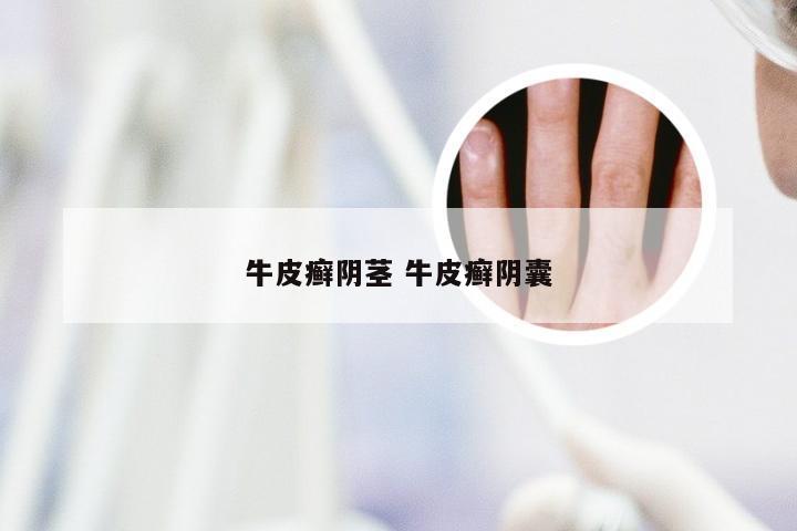 牛皮癣阴茎 牛皮癣阴囊
