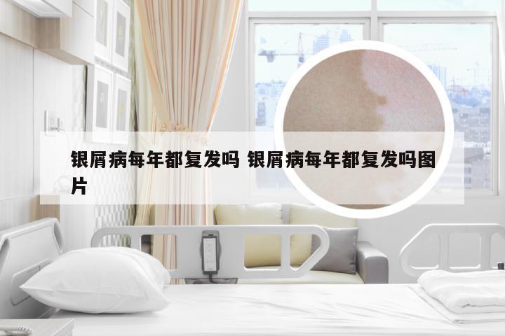 银屑病每年都复发吗 银屑病每年都复发吗图片