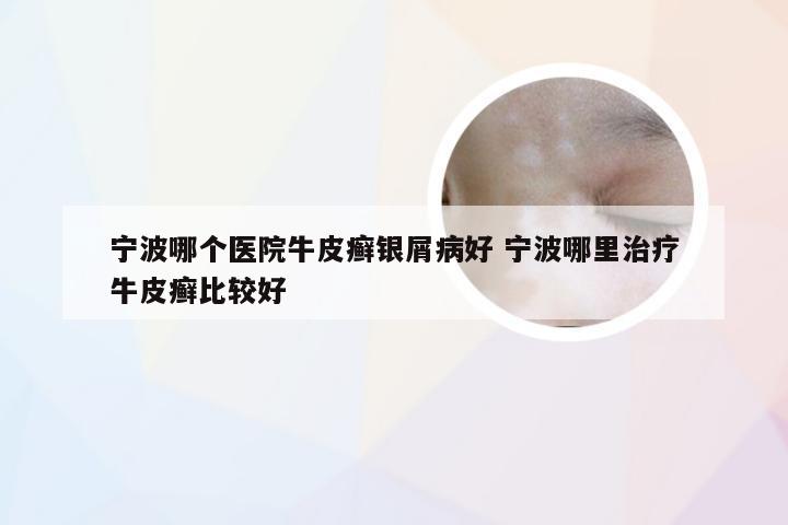 宁波哪个医院牛皮癣银屑病好 宁波哪里治疗牛皮癣比较好