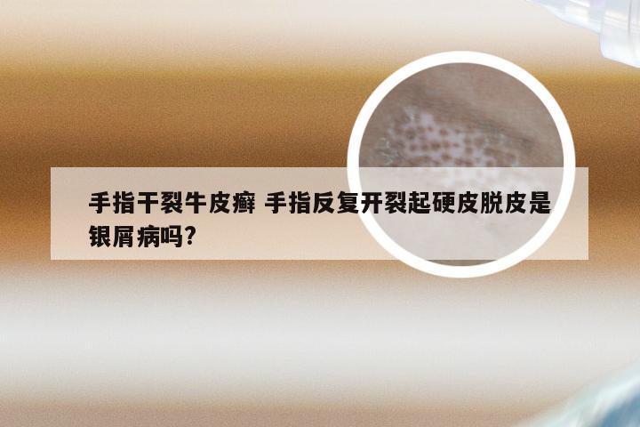 手指干裂牛皮癣 手指反复开裂起硬皮脱皮是银屑病吗?