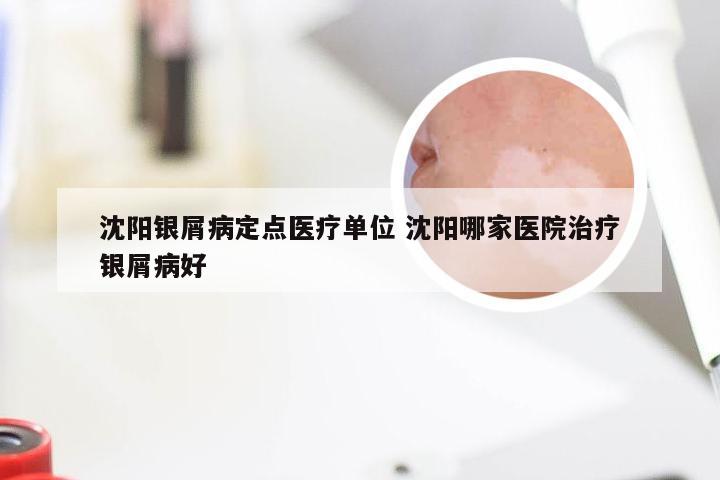 沈阳银屑病定点医疗单位 沈阳哪家医院治疗银屑病好