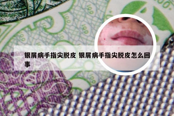 银屑病手指尖脱皮 银屑病手指尖脱皮怎么回事