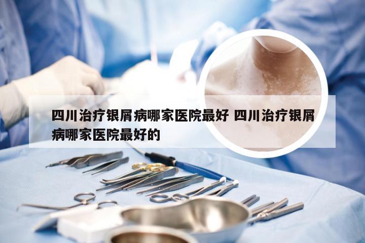 四川治疗银屑病哪家医院最好 四川治疗银屑病哪家医院最好的