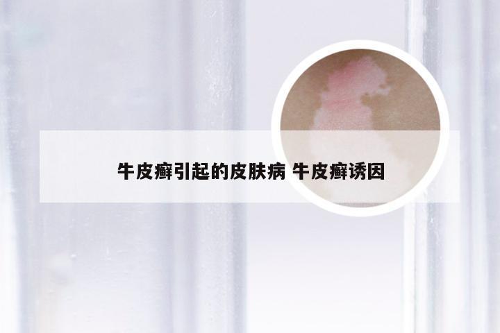 牛皮癣引起的皮肤病 牛皮癣诱因