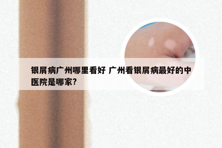 银屑病广州哪里看好 广州看银屑病最好的中医院是哪家?