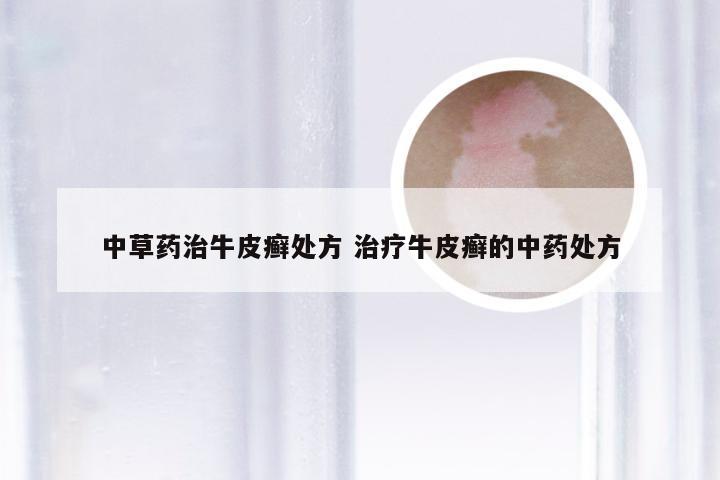 中草药治牛皮癣处方 治疗牛皮癣的中药处方