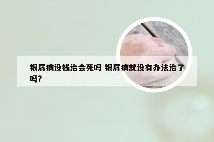 银屑病没钱治会死吗 银屑病就没有办法治了吗?