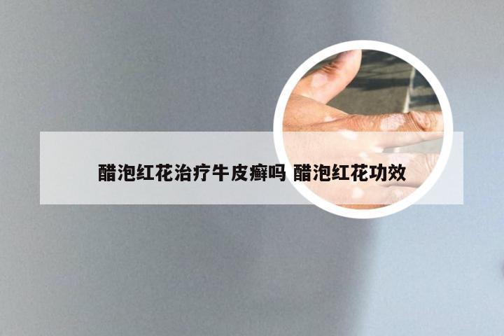 醋泡红花治疗牛皮癣吗 醋泡红花功效