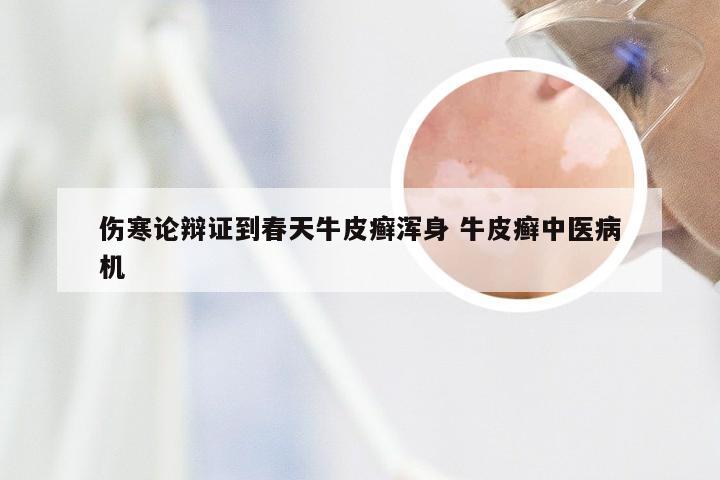 伤寒论辩证到春天牛皮癣浑身 牛皮癣中医病机