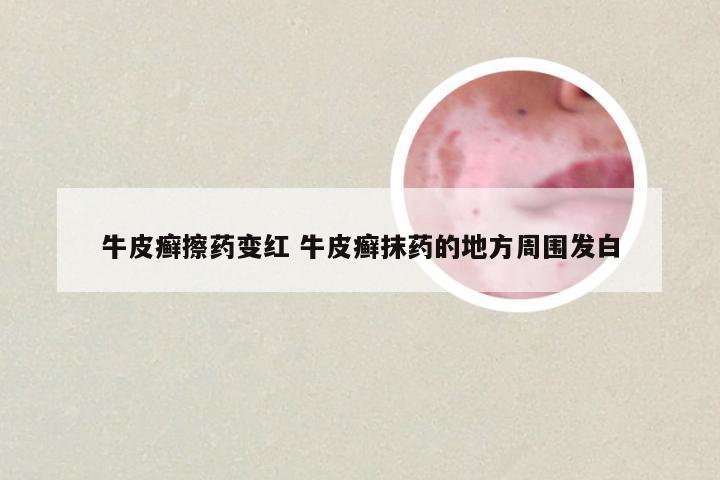 牛皮癣擦药变红 牛皮癣抹药的地方周围发白