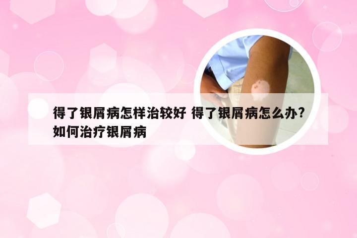 得了银屑病怎样治较好 得了银屑病怎么办?如何治疗银屑病