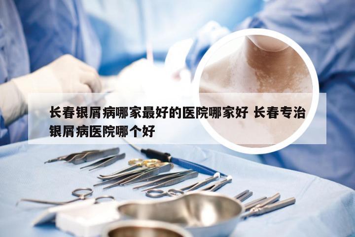长春银屑病哪家最好的医院哪家好 长春专治银屑病医院哪个好