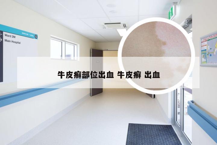 牛皮癣部位出血 牛皮癣 出血