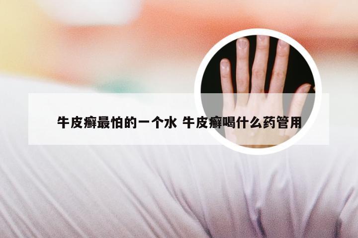 牛皮癣最怕的一个水 牛皮癣喝什么药管用
