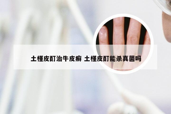 土槿皮酊治牛皮癣 土槿皮酊能杀真菌吗