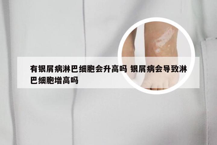 有银屑病淋巴细胞会升高吗 银屑病会导致淋巴细胞增高吗