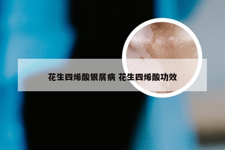 花生四烯酸银屑病 花生四烯酸功效