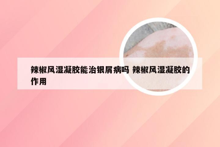 辣椒风湿凝胶能治银屑病吗 辣椒风湿凝胶的作用