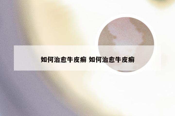如何治愈牛皮癣 如何治愈牛皮癣