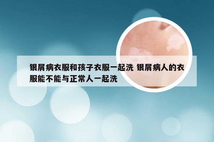 银屑病衣服和孩子衣服一起洗 银屑病人的衣服能不能与正常人一起洗