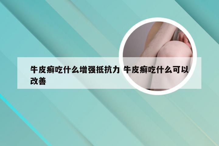 牛皮癣吃什么增强抵抗力 牛皮癣吃什么可以改善