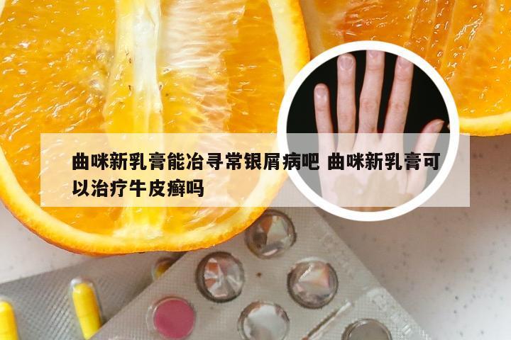 曲咪新乳膏能冶寻常银屑病吧 曲咪新乳膏可以治疗牛皮癣吗