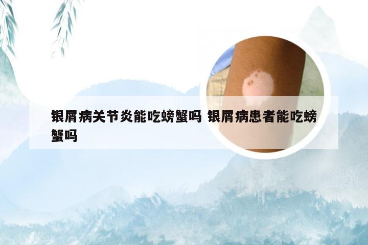 银屑病关节炎能吃螃蟹吗 银屑病患者能吃螃蟹吗