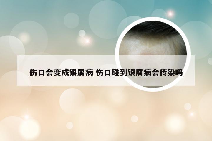 伤口会变成银屑病 伤口碰到银屑病会传染吗