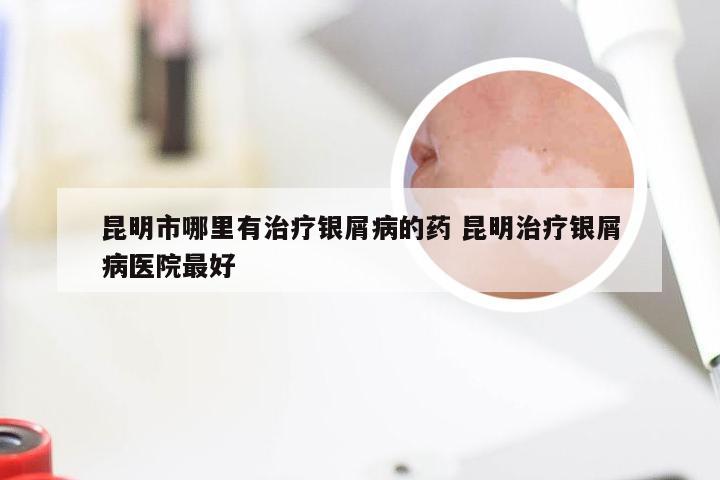 昆明市哪里有治疗银屑病的药 昆明治疗银屑病医院最好