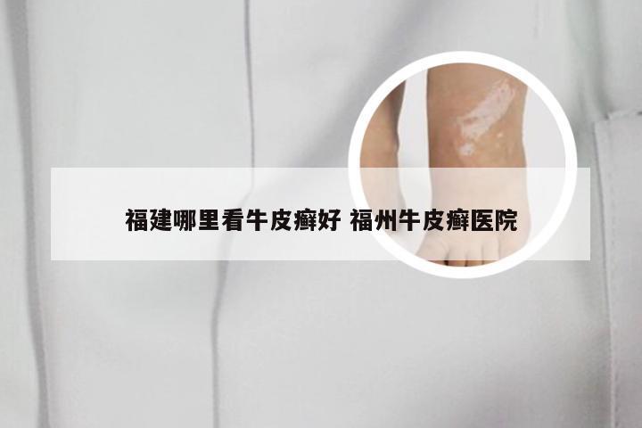 福建哪里看牛皮癣好 福州牛皮癣医院