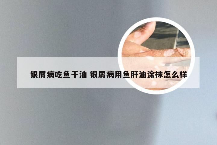 银屑病吃鱼干油 银屑病用鱼肝油涂抹怎么样