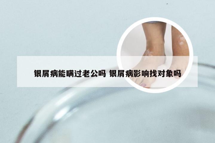 银屑病能瞒过老公吗 银屑病影响找对象吗