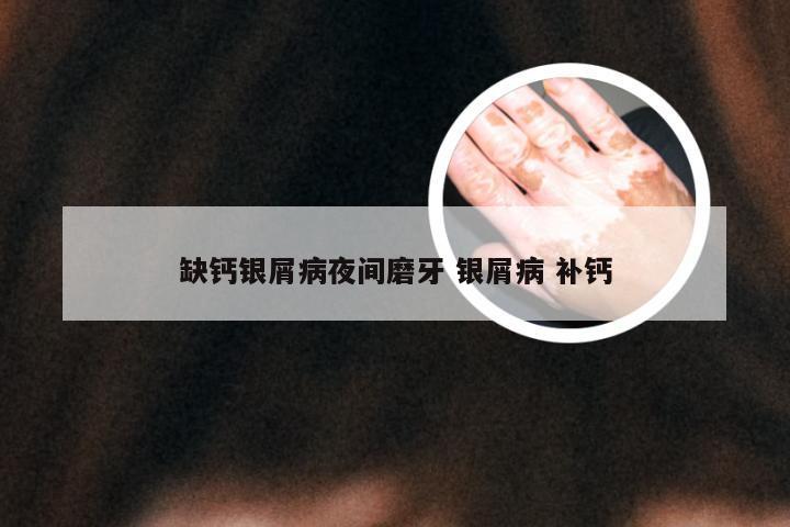 缺钙银屑病夜间磨牙 银屑病 补钙