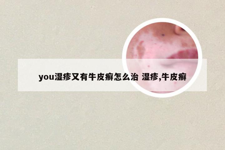 you湿疹又有牛皮癣怎么治 湿疹,牛皮癣
