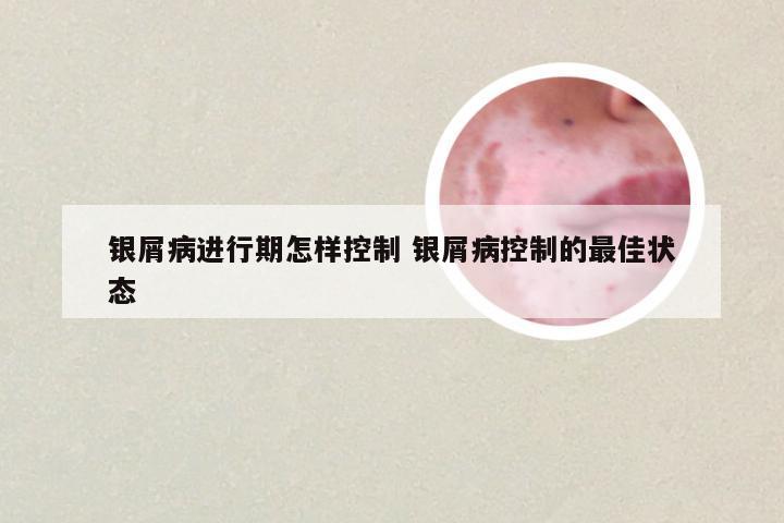 银屑病进行期怎样控制 银屑病控制的最佳状态