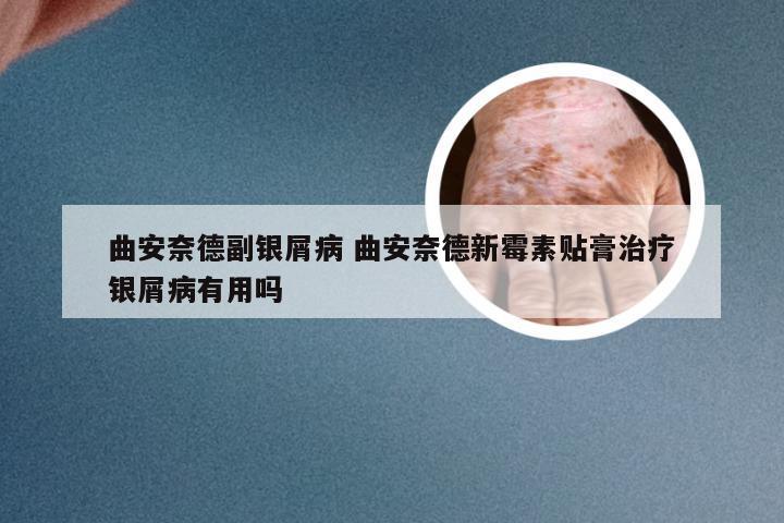 曲安奈德副银屑病 曲安奈德新霉素贴膏治疗银屑病有用吗