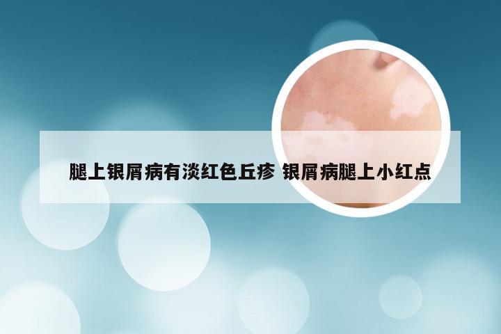 腿上银屑病有淡红色丘疹 银屑病腿上小红点