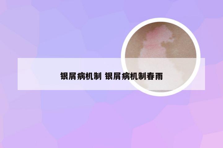 银屑病机制 银屑病机制春雨